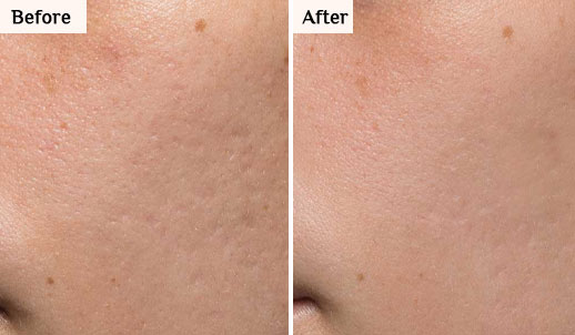 morpheus8 before after abdomen